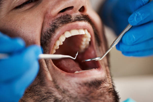 Best Knocked-Out Tooth (Avulsed Tooth) Treatment in Big Lake, TX